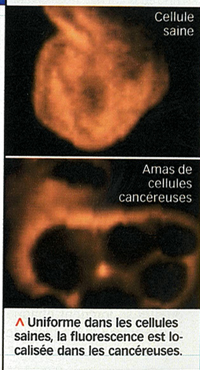 Fluorescence comparée de cellules saines et tumorales